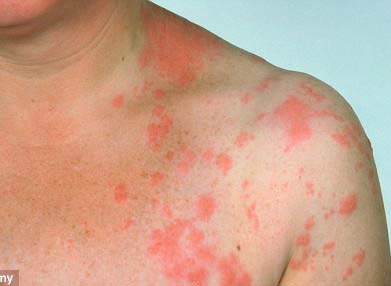 bệnh zona người cao tuổi