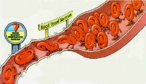 cao huyet ap la gi 2 Cao huyết áp là gì?