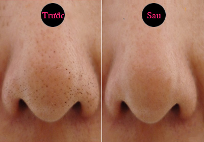 trị ụn đầu đen