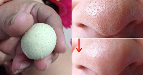 trị mụn